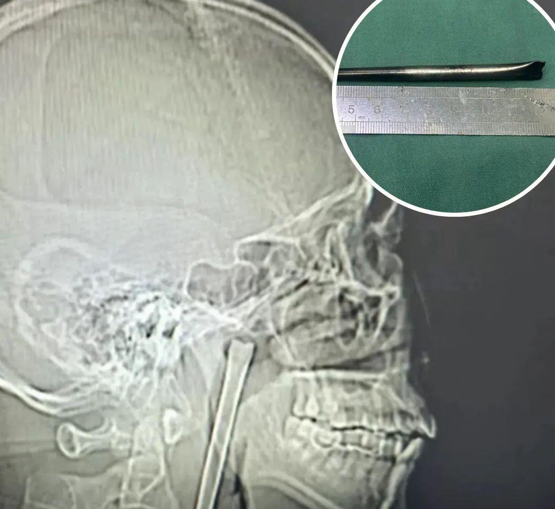 షాకింగ్ ఘటన: గొంతులో 8 ఏళ్ల పాటు మెటల్ చాప్‌స్టిక్