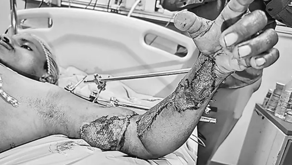 అరుదైన శస్త్రచికిత్స.. తెగిపోయిన చేతిని మళ్లీ అమర్చిన ఎయిమ్స్ వైద్యులు